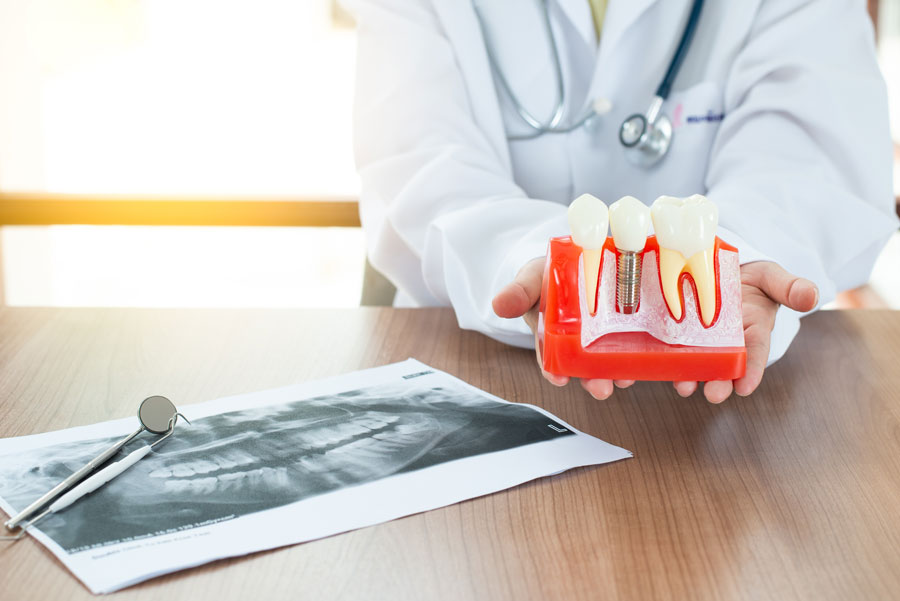 Everything you need to know about dental implants