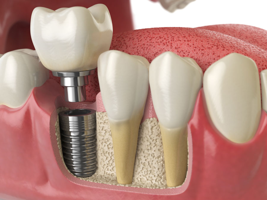Dental implants – Giving you the opportunity to transform your smile