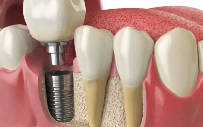 Dentalni implantati – mogućnost da transformišete svoj osmeh